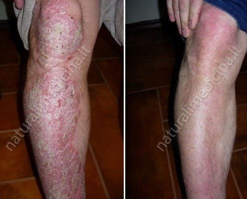 Receptas nuo žvynelinės ir antsvorio